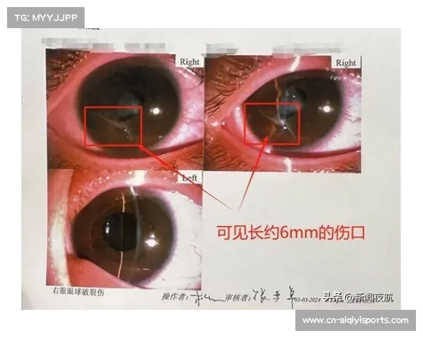 冠军视力受损,角膜擦伤需休养两月 冠军视力受损,角膜擦伤需休养两月